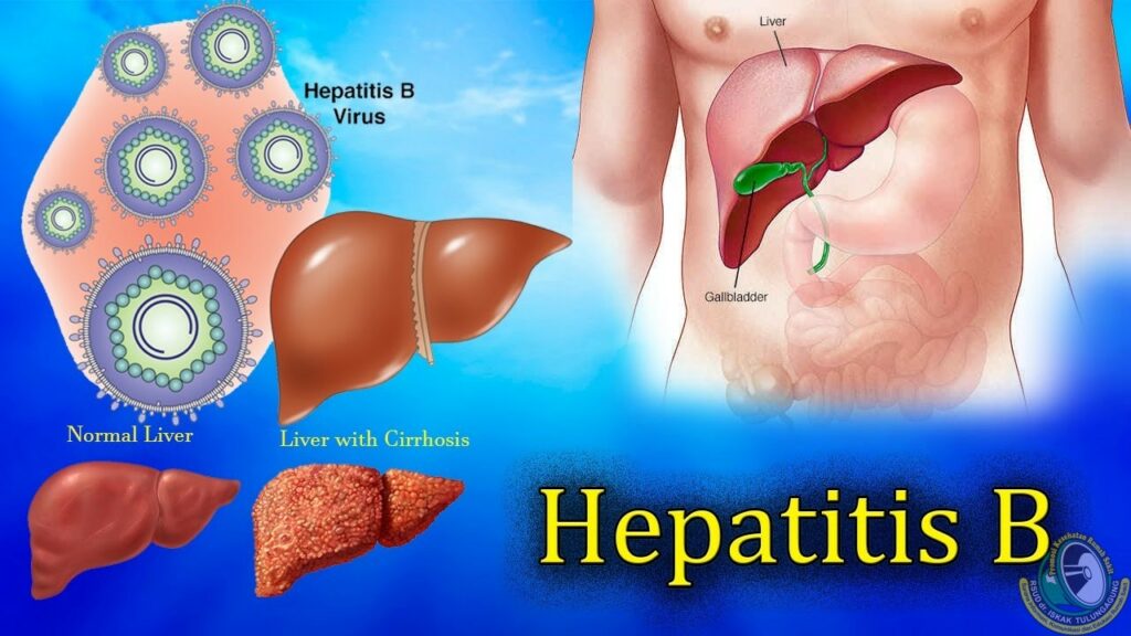 Hepatitis B Banyak Ditularkan Ibu ke Anak, Begini Cara Mencegahnya/Ist
